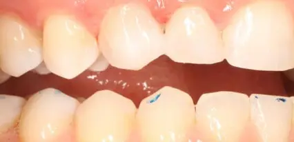 after close up smile view of restored upper front tooth perfectly matched