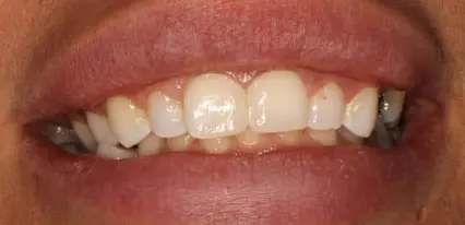 after close up view of upper arch with no-prep veneers closing central space