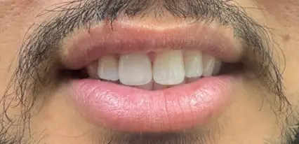 after close up view of upper side teeth with composite bonding closing the gap