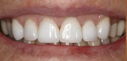 after smile view of restored upper arch with uniform white porcelain crowns