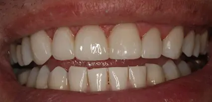 after smile view showing smooth even front teeth restored with cosmetic bonding