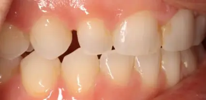 before close up smile view of a discolored yellowed upper central tooth