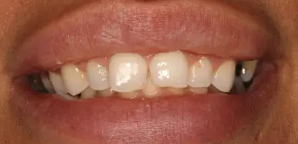 before close up view of misaligned front bite with a gap between central incisors