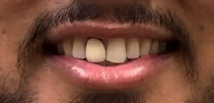 before close up view of side bite with minor gap between upper lateral teeth