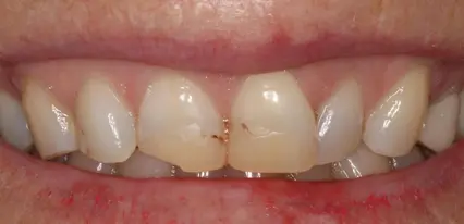 before smile view of discolored worn front teeth with chipped central edges